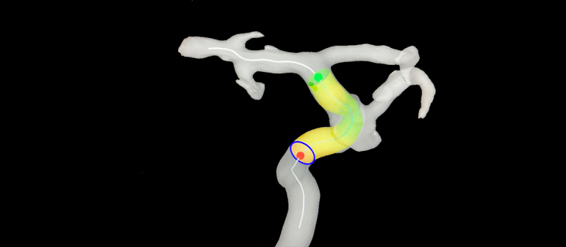 Malformación arteriovenosa cerebral