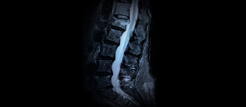 Fractura vertebral