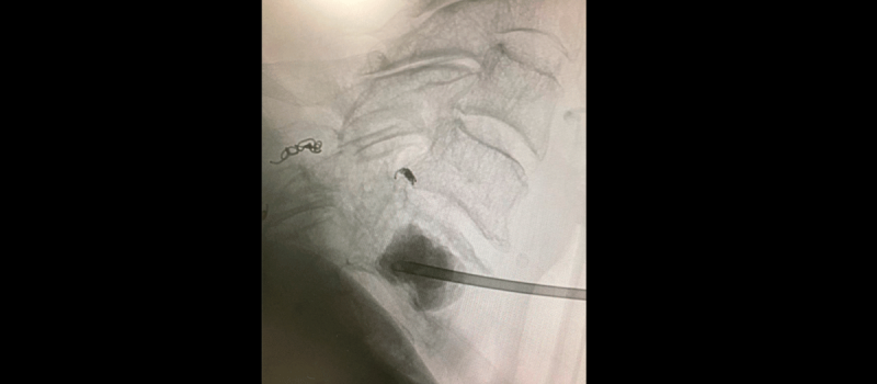 fx-vertebral2