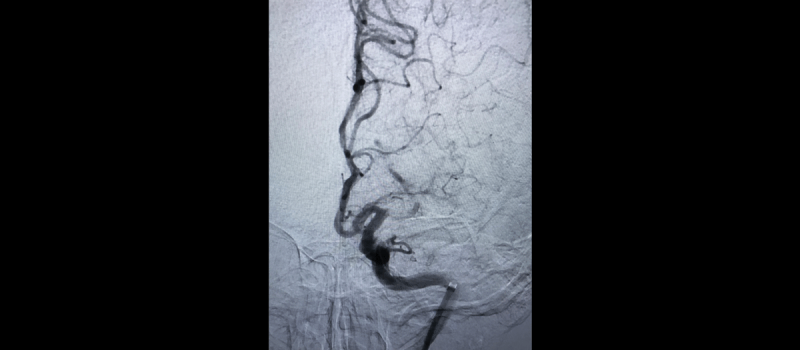 trombectomia-mecanica-antes